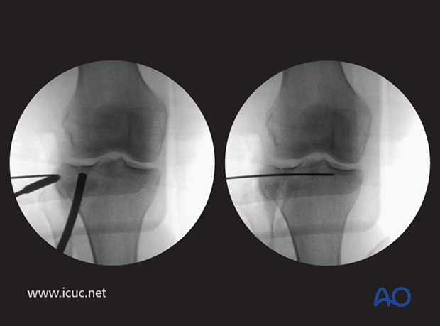 This image shows the joint surface reduced and the disimpactor maintaining reduction with a lateral K-wire is inserted beneath the joint surface.