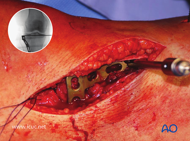 A lateral tibial plateau buttress plate is carefully inserted at the correct height.