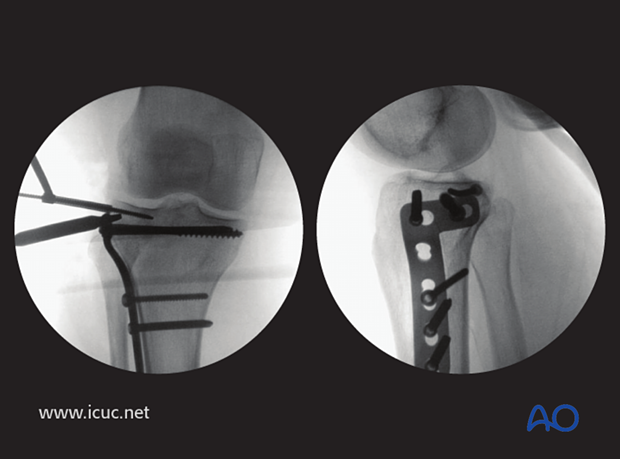 This image shows an extra subchondral raft screw being inserted to support the joint surface.