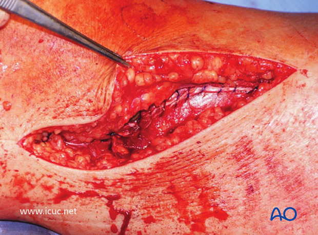 The anterior compartment may be closed if compartment syndrome is not a threat.