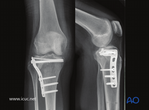 12-week image showing a very good reduction but some loss of joint height despite raft screws