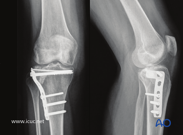 Nearly one year later, bone substitute can still be seen and small loss of joint height is evident.