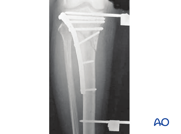 orif plates without angular stability