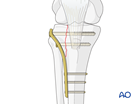 partial articular fracture split