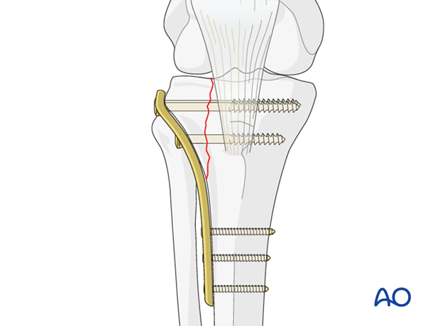partial articular fracture split