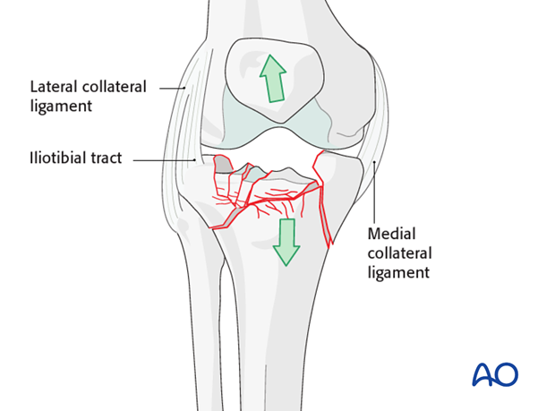 Ring external fixator (definitive) for Complete articular fracture,  fragmentary articular