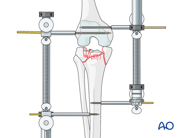 Ring external fixator (definitive) for Complete articular fracture,  fragmentary articular