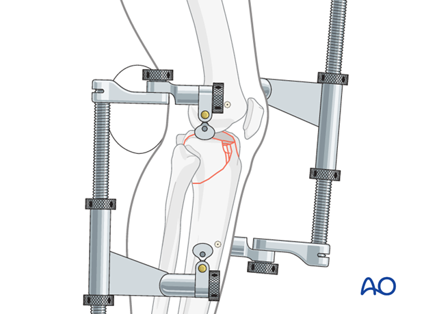 Ring external fixator (definitive) for Complete articular fracture,  fragmentary articular