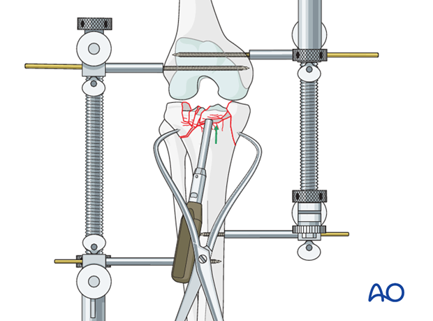 Circular external fixator application for midshaft tibial