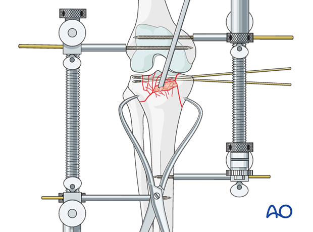 Ring external fixator (definitive) for Complete articular fracture