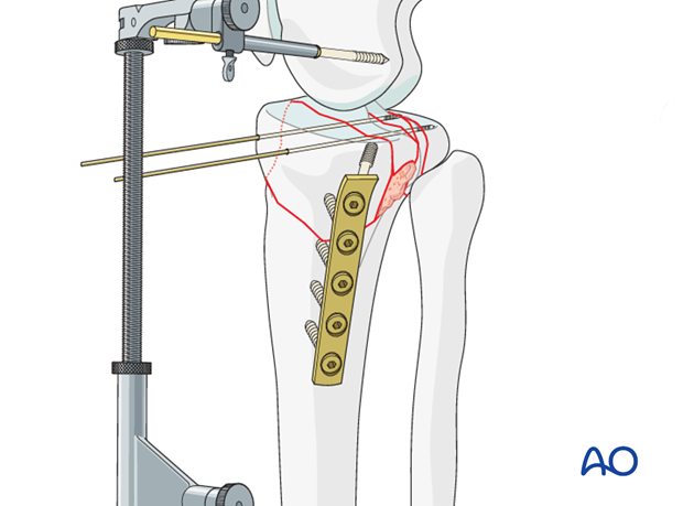 Plate application on medial side