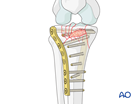complete articular fracture fragmentary articular