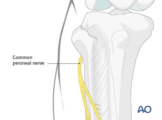 Lag screws for Extraarticular fracture, avulsion of fibular head