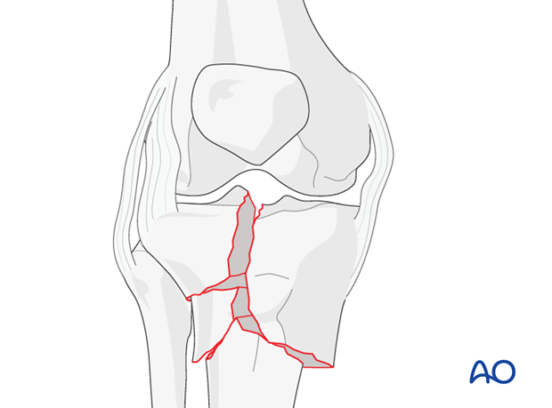 C2-type fracture