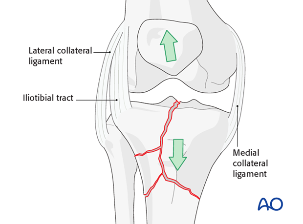Ligamentotaxis helps to achieve preliminari reduction 