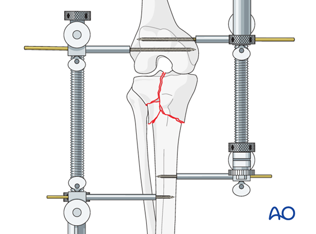 Use of distractors and external fixators