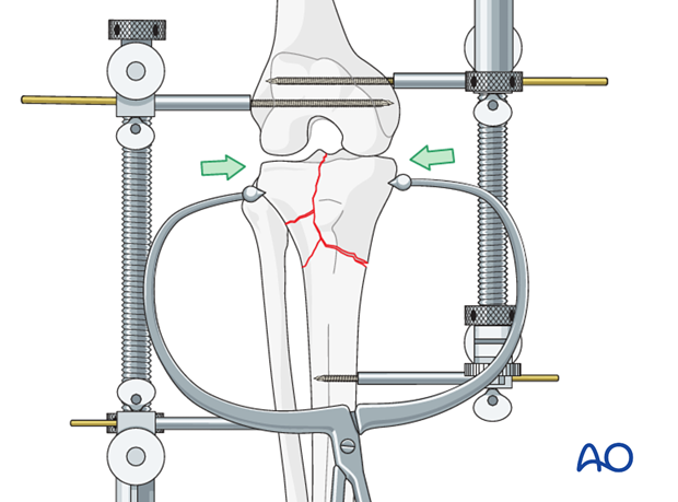 Reduction of the articular surface with clamps