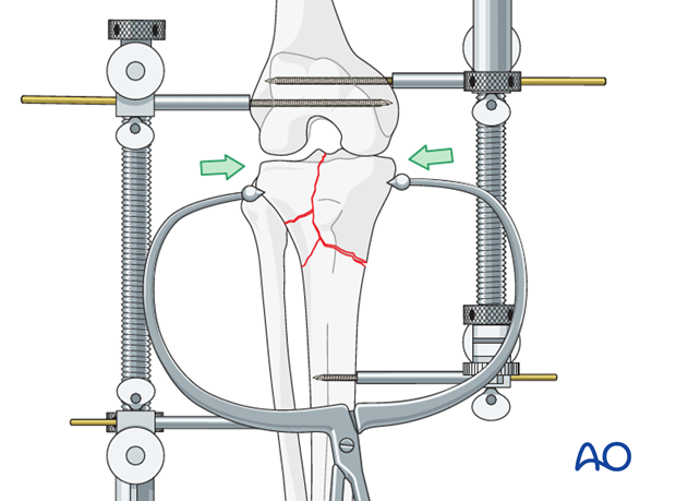 Ring external fixator (definitive) for Complete articular fracture