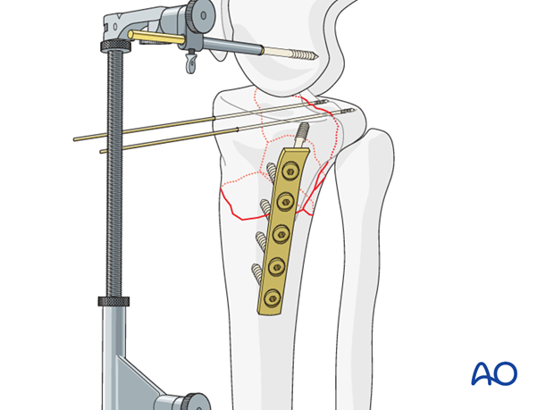 Plate application on medial side