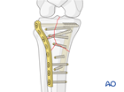 complete articular fracture simple articular multifragmentary metaphyseal