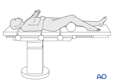 ORIF - Plates without angular stability for Extraarticular fracture ...