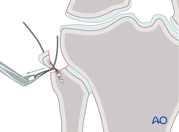 suture anchors