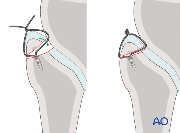 suture anchors