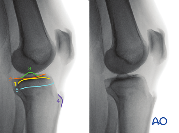 Anatomical landmarks and lines in the optimal lateral view of the proximal tibia