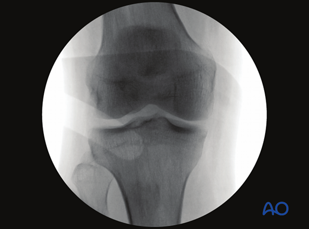 Verification of optimal AP view of the proximal tibia with 10° cephalic tilt