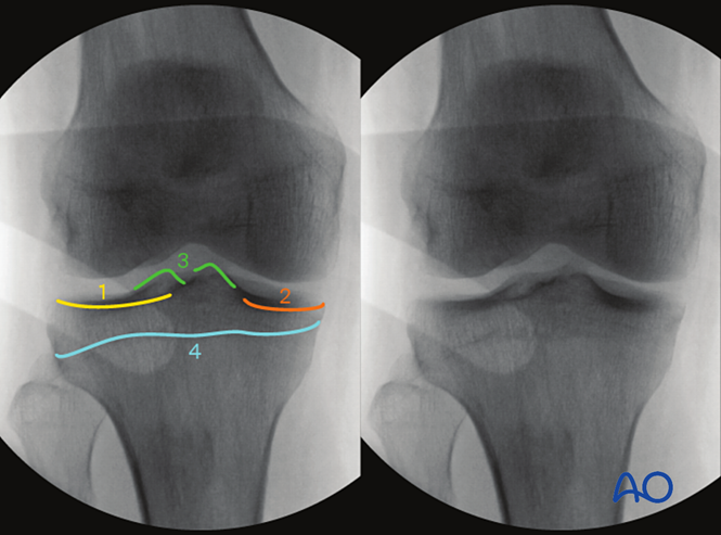 Intraoperative imaging of the proximal tibia
