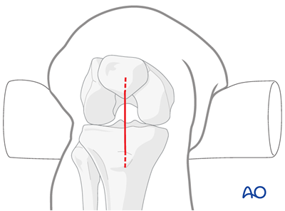 Nailing limited open approach to the distal tibia