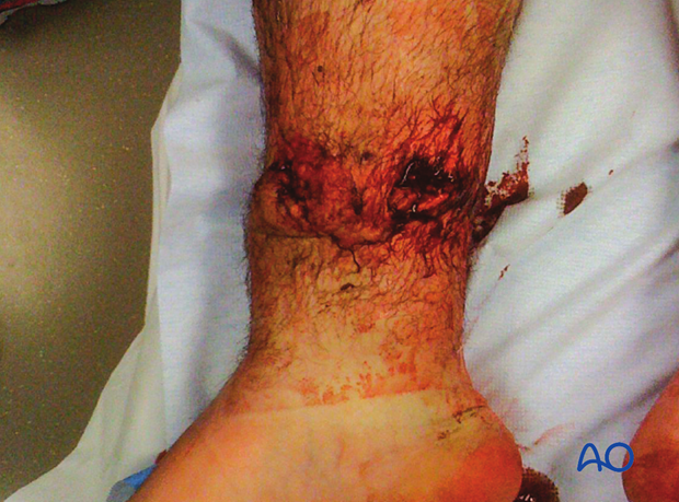 42_A010_i020 The approach to the anterolateral surface of the tibial shaft may be necessary when medial soft tissues are compromised.