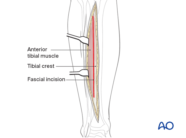 42_A010_i050 The fascia is incised just lateral to the tibial crest.