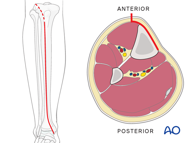Approach to the anteromedial surface of the tibial shaft