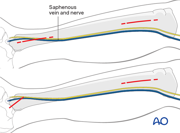Minimally  invasive medial approach to the tibial shaft – skin incisions.