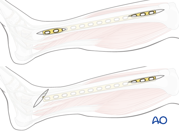 Minimally  invasive medial approach to the tibial shaft – plate position and straight and distal incisions.