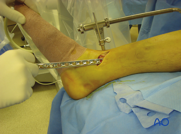 Minimally  invasive medial approach to the tibial shaft – A large distractor helps to reduce and stabilize the fracture.