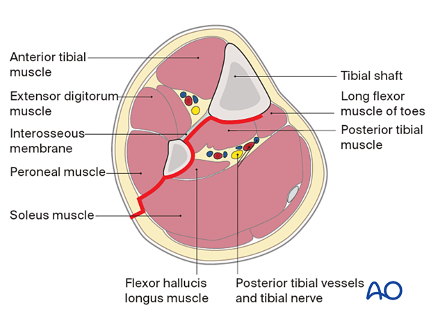 Approach to the posterolateral surface of the tibial shaft