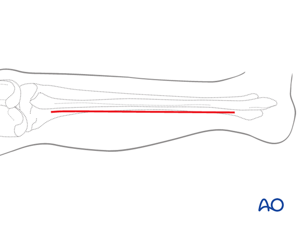 Approach to the posterolateral surface of the tibial shaft - skin incision