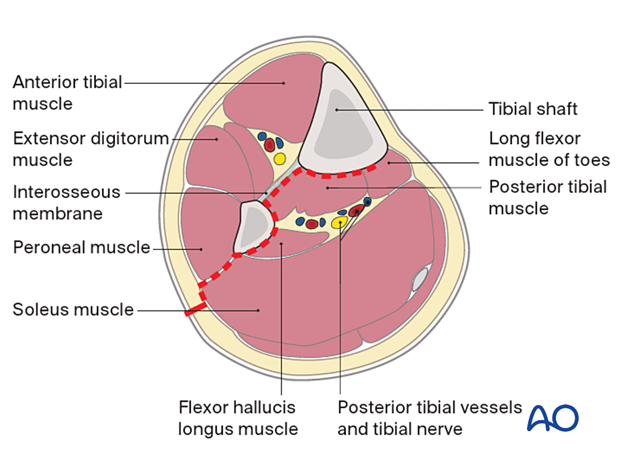 Approach to the posterolateral surface of the tibial shaft  - the interval between the lateral and posterior compartments is usually easier to find distally.