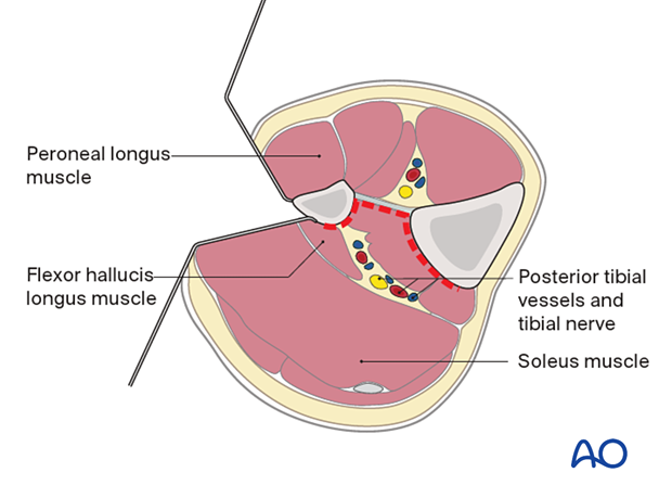 Approach to the posterolateral surface of the tibial shaft - the plane of the dissection will be between the superficial posterior and lateral compartments.