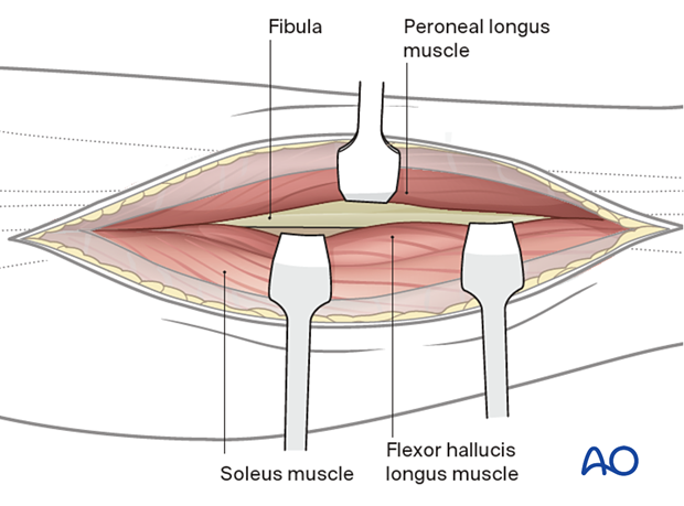 Approach to the posterolateral surface of the tibial shaft - often there are crossing perforating branches of the peroneal vessels, which must be ligated.