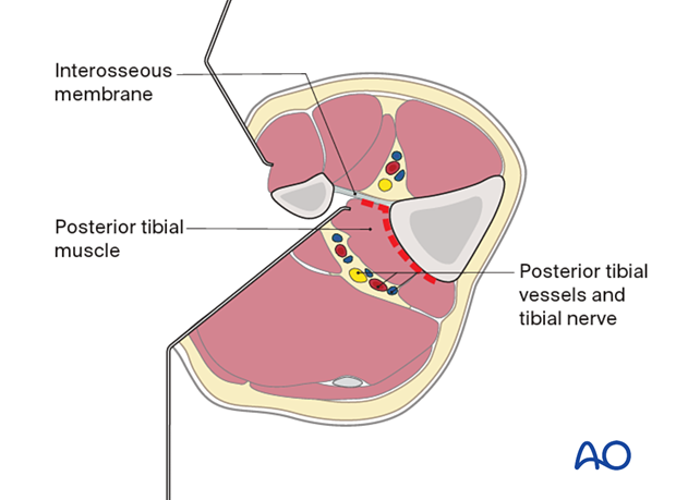 Approach to the posterolateral surface of the tibial shaft - The Flexor hallucis longus (FHL) arises from the posterior aspect of the fibula. This is mobilized posteromedially.