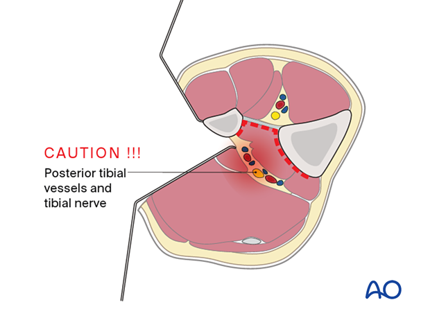 Approach to the posterolateral surface of the tibial shaft - one should proceed with caution when mobilizing the deep posterior compartment.