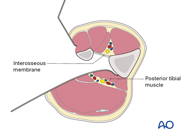 Approach to the posterolateral surface of the tibial shaft - mobilize the remainder of the deep posterior compartment medially until the posterior aspect of the tibia is encountered.
