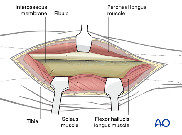 Approach to the posterolateral surface of the tibial shaft - at the conclusion of the dissection the surgeon should have access to the posterior aspects of both the tibia and the fibula.