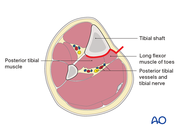 Approach to the posteromedial surface of the tibial shaft