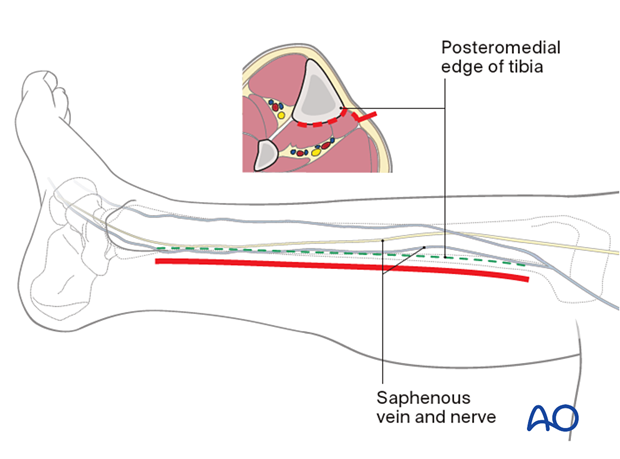 42_A060_i040 Approach to the posteromedial surface of the tibial shaft - skin incision