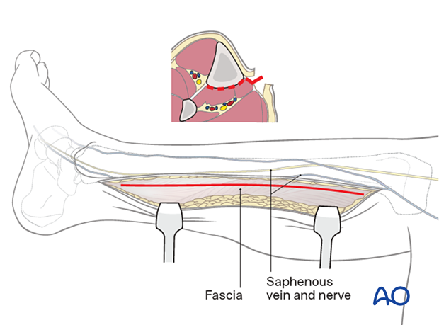42_A060_i060 Approach to the posteromedial surface of the tibial shaft - subcutaneous dissection is carried out carefully so as to identify and/or protect the saphenous vein and nerve.