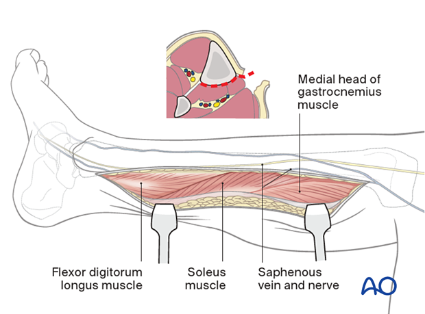42_A060_i080 Approach to the posteromedial surface of the tibial shaft - the fascia is incised in line with the skin incision and the superficial and deep posterior compartments are mobilized.